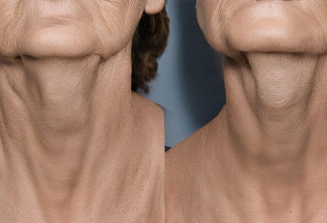 Revitalize Your Appearance with a Neck Lift in Bangkok, Thailand