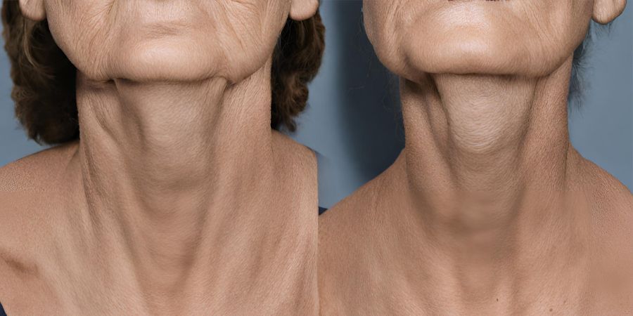 Revitalize Your Appearance with a Neck Lift in Bangkok, Thailand